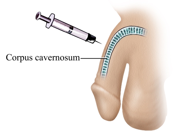 Erectile dysfunction treatment City of Hope California